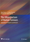 The Ultrastructure of Human Tumours-1