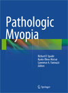 Pathologic Myopia-1