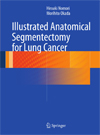 Illustrated Anatomical Segmentectomy for Lung Cancer-1