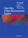 Color Atlas of Burn Reconstructive Surgery-1