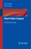 Heart Valve Surgery -1