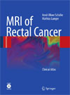 MRI of Rectal Cancer-1