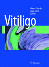 Vitiligo-1