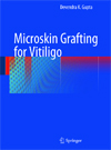 Microskin Grafting for Vitiligo-1
