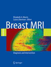 Breast MRI-1