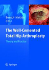The Well Cemented Total Hip Arthroplasty-1