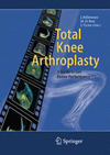 Total Knee Arthroplasty-1